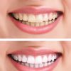 Преимущества отбеливания зубов